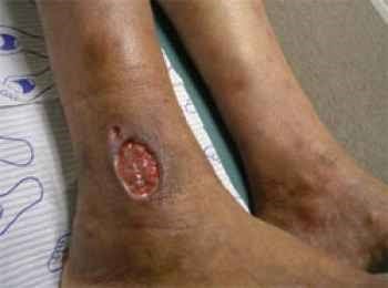varicose veins cause