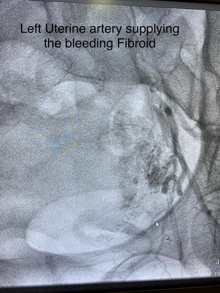 Uterine bleeding from fibroids 4