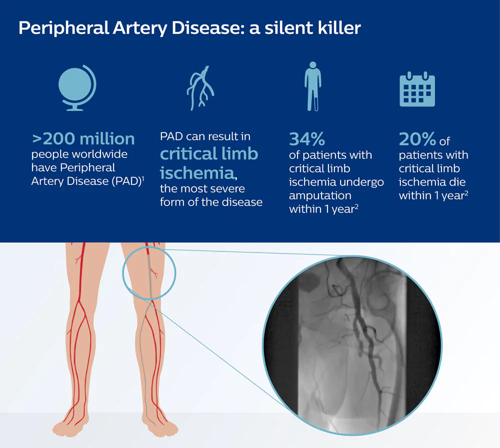 Peripheral Artery Disease Infographic