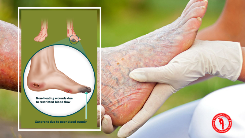 Advanced Care For Critical Limb Ischemia CLI Best Vascular Surgeons 