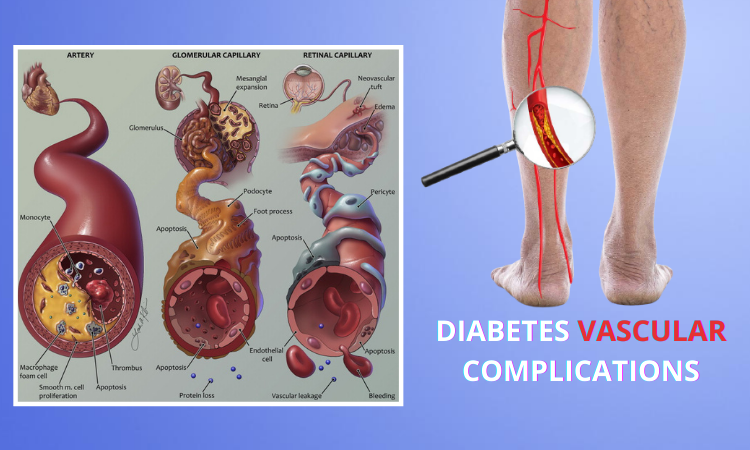 Diabetes Vascular Complications
