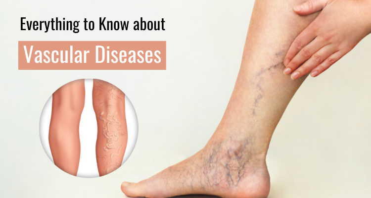 Everything to Know about Vascular Diseases