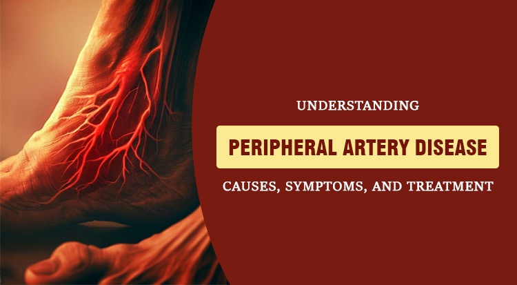 peripheral-artery-disease